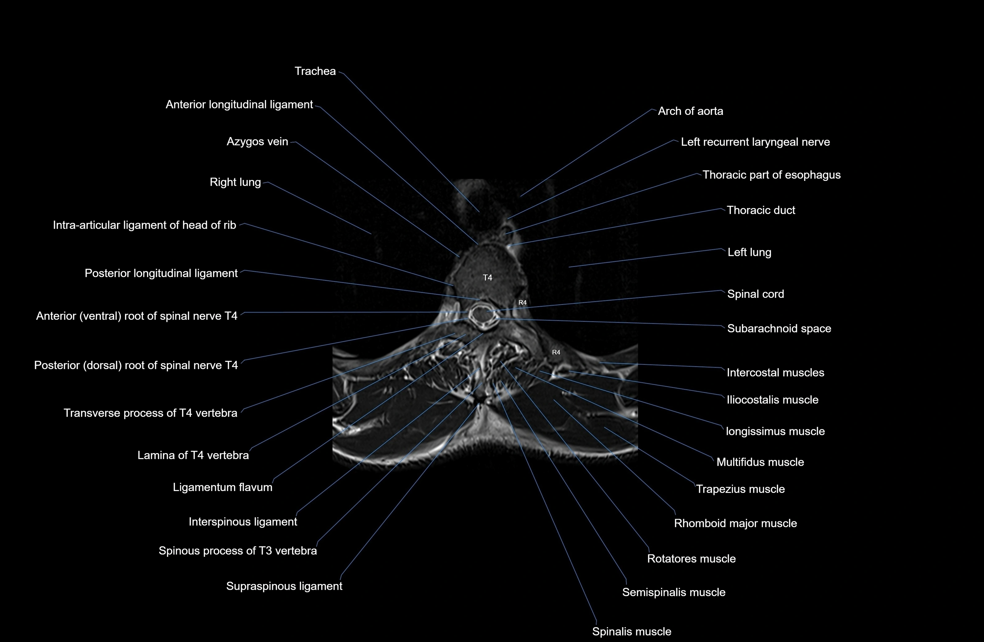 MRI thoracic spine axial  cross sectional anatomy 3T radiology  image-img-00001-00025.webp